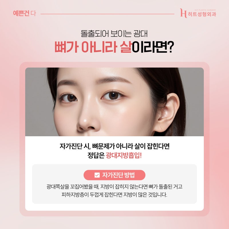 [히트성형외과] 광대뼈 문제가 아니라면 광대살 지방흡입으로! 사진 3