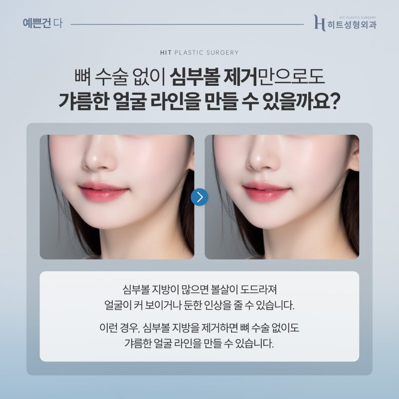 [히트성형외과] 뼈 수술 없이 갸름해지는 방법? 심부볼 지방 흡입!