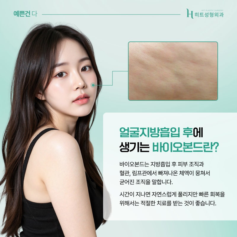 [히트성형외과] 얼굴지방흡입 후 바이오본드가 생기는 이유는? 사진 4