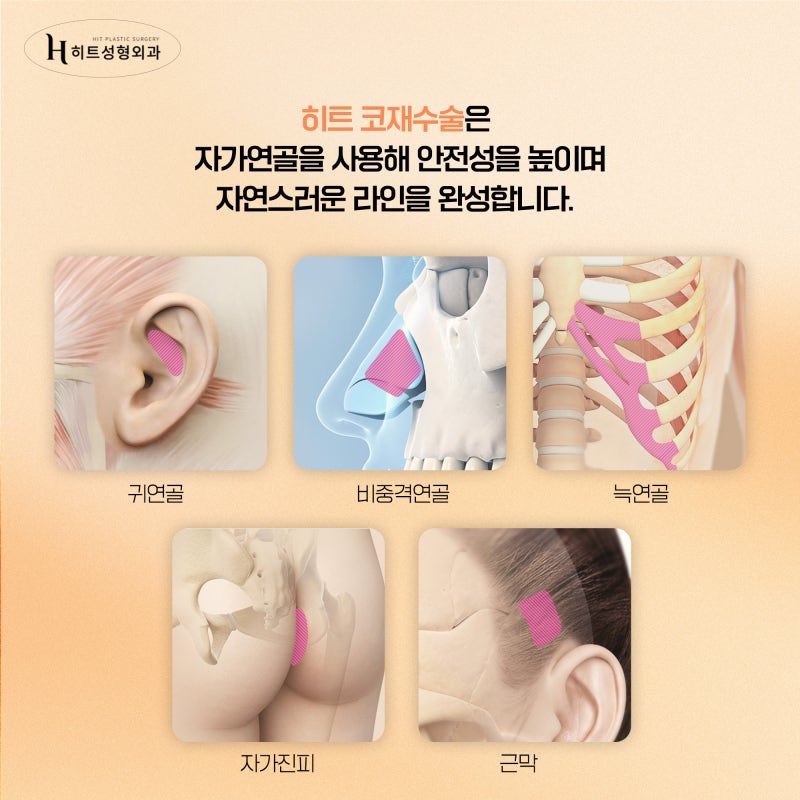[히트성형외과] 코재수술이 고민될 땐 맞춤 가이드를 확인하기! 사진 4