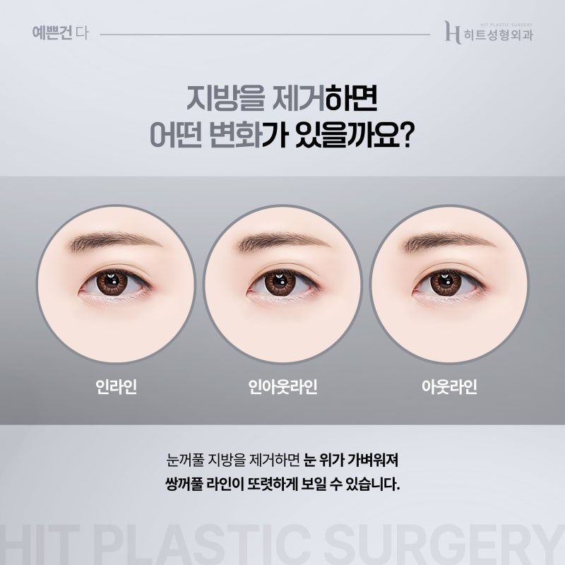 [히트성형외과] 두툼한 눈두덩이, 지방제거만이 해결 방법일까요? 사진 3