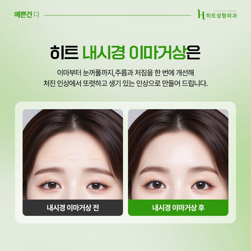 [히트성형외과] 눈꺼풀 처짐으로 생긴 인상 변화, 해결 방법은? 사진 5
