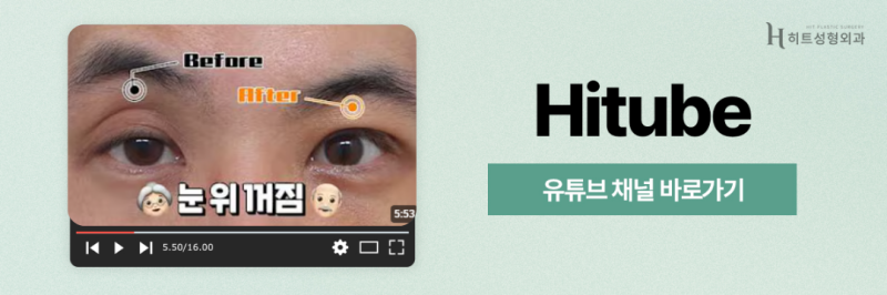 [히트성형외과] 처진 눈꺼풀에 눈썹 하거상이 필요한 이유! 사진 8