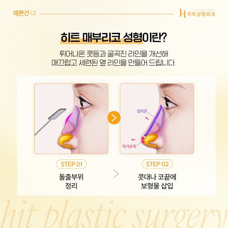 [히트성형외과] 내 코는 어떤 유형일까? 사진 4