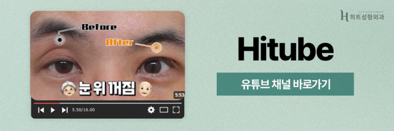 [히트성형외과] 중년눈매, 상안검으로 또렷하게 리셋 사진 8