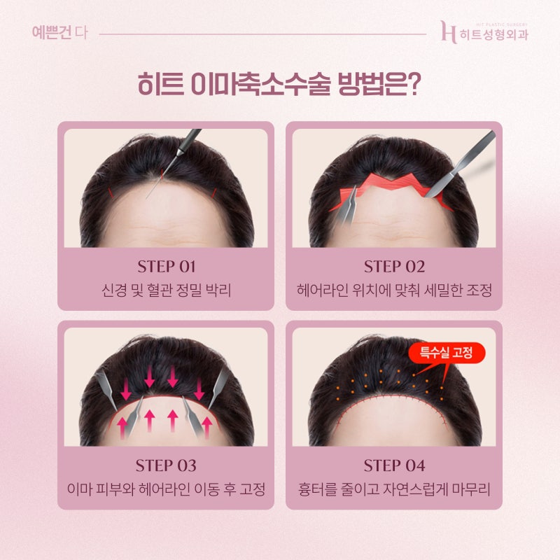 [히트성형외과] 이마축소술 전 꼭 알아야 할 디자인 팁! 사진 4