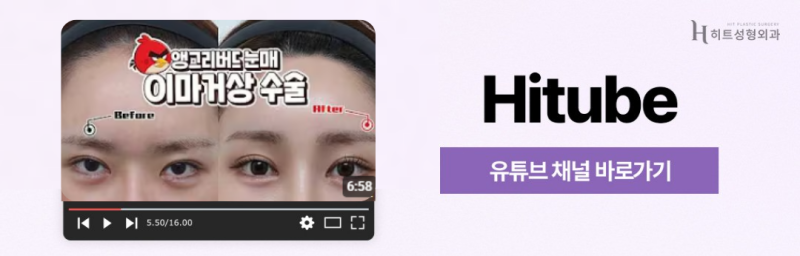 [히트성형외과] 얼굴형에 맞춘 흐름이 포인트인 이마축소! 사진 8