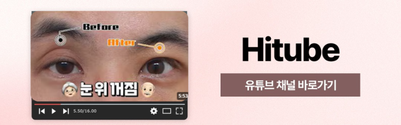 [히트성형외과] 중년 상안검 수술로 피곤한 인상 탈출! 사진 8