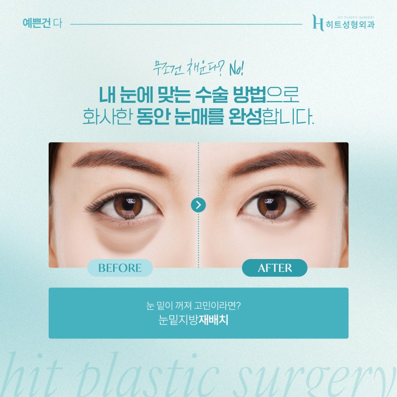 [히트성형외과] 눈밑지방재배치! 30대 이후에 더 추천되는 이유는? 사진 3