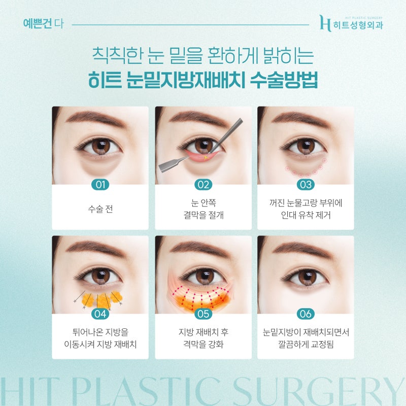 [히트성형외과] 눈밑지방재배치! 30대 이후에 더 추천되는 이유는? 사진 4