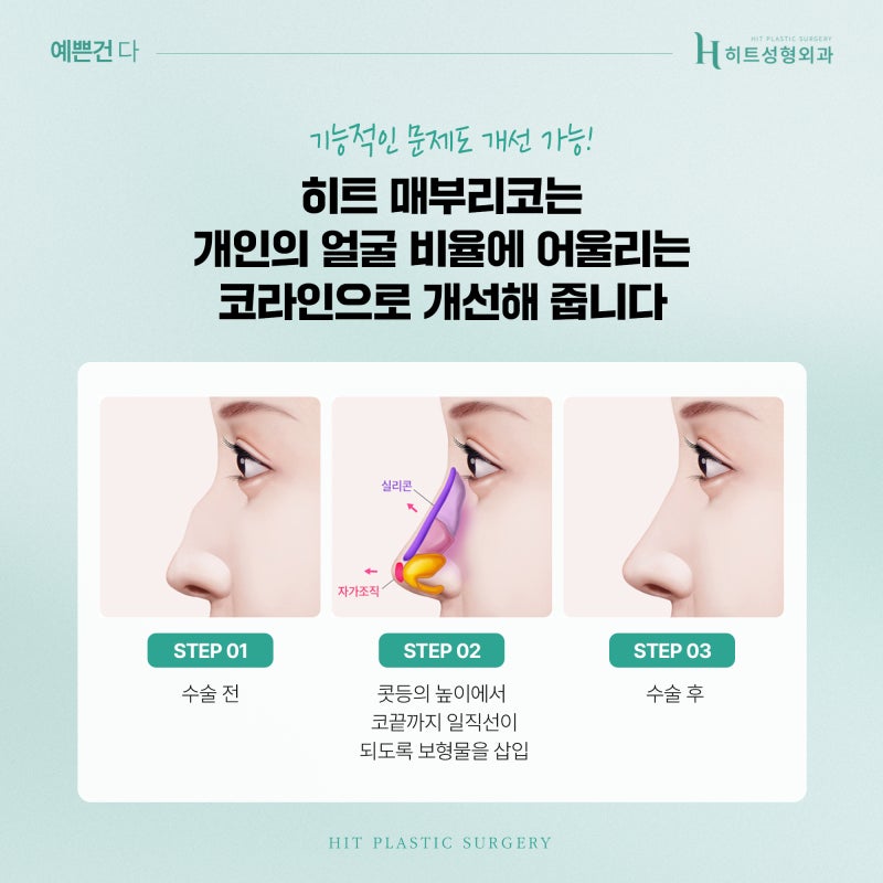 [히트성형외과] 쌍꺼풀 라인 높이에 따라 인상이 달라진다! 사진 4