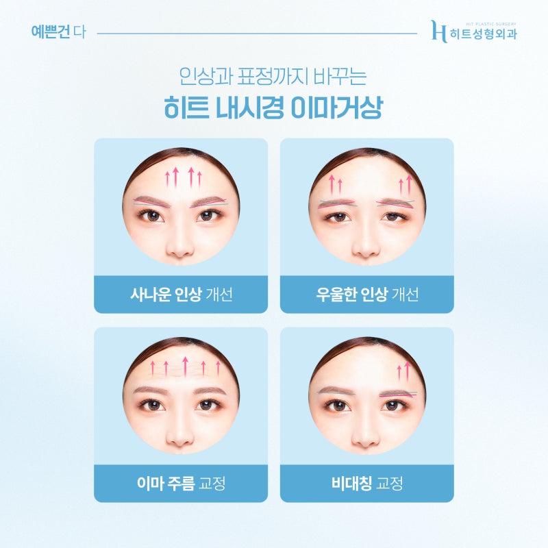 [히트성형외과] 이마거상과 축소, 함께 하면 어떤 효과가 있을까? 사진 4