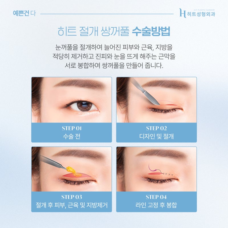 [히트성형외과] 눈매 교정의 정석! 절개 쌍꺼풀로 선명하게 사진 4