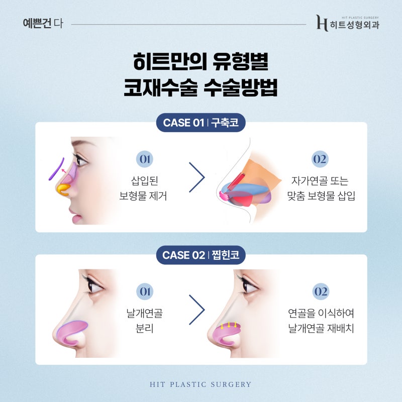 [히트성형외과] 코재수술, 최소 대기 기간이 필요한 이유는? 사진 4