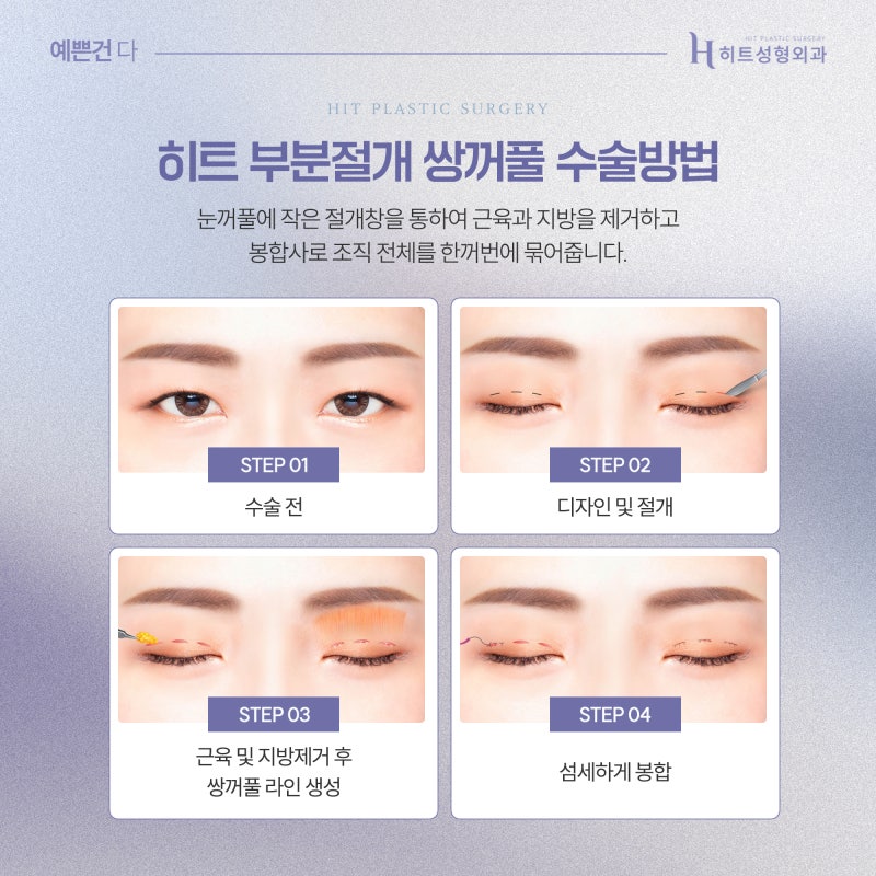 [히트성형외과] 부분절개 쌍꺼풀! 오래가는 시원한 눈매로 사진 4