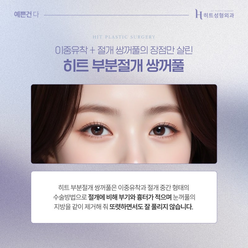 [히트성형외과] 부분절개 쌍꺼풀! 오래가는 시원한 눈매로
