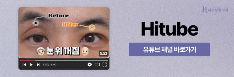 [히트성형외과] 부분절개 쌍꺼풀! 오래가는 시원한 눈매로 사진 8