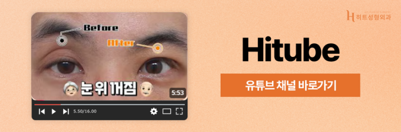 [히트성형외과] 눈 뜨는 힘이 부족하다면 혹시 안검하수? 사진 8