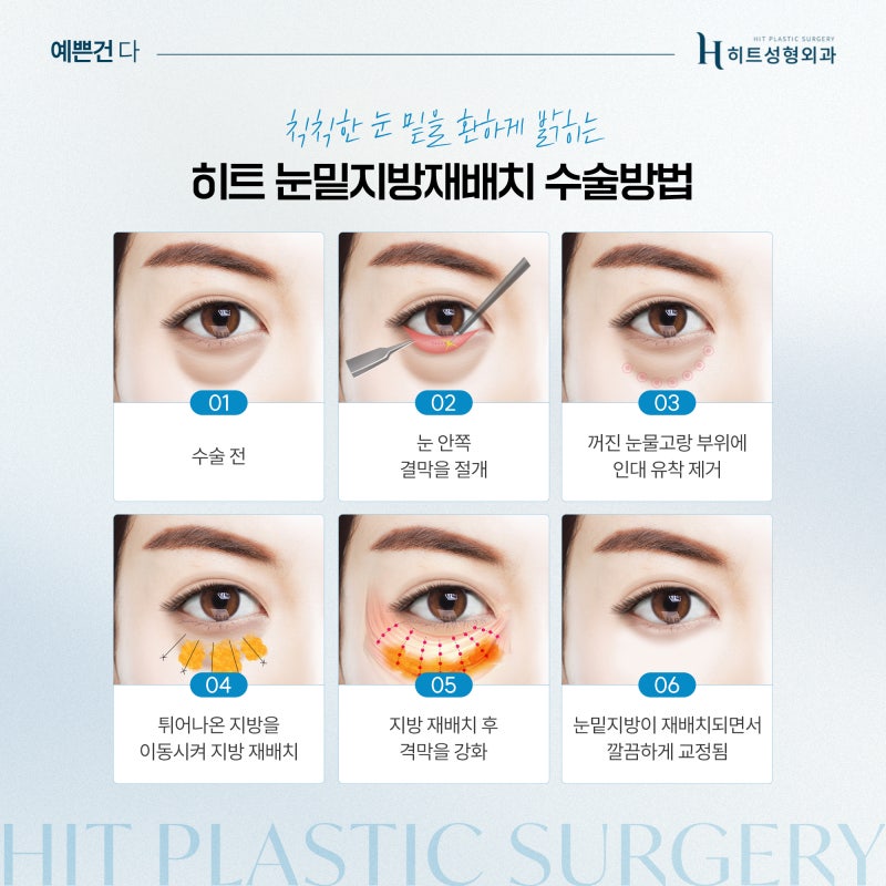 [히트성형외과] 눈 밑 다크서클, 눈밑지방재배치로 개선할 수 있을까? 사진 4