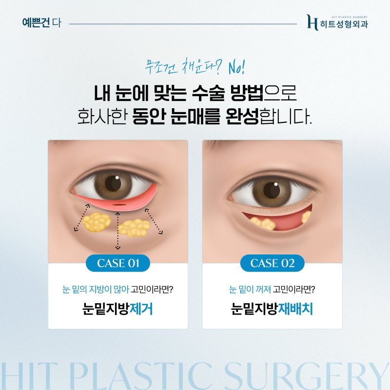 [히트성형외과] 눈 밑 다크서클, 눈밑지방재배치로 개선할 수 있을까? 사진 3