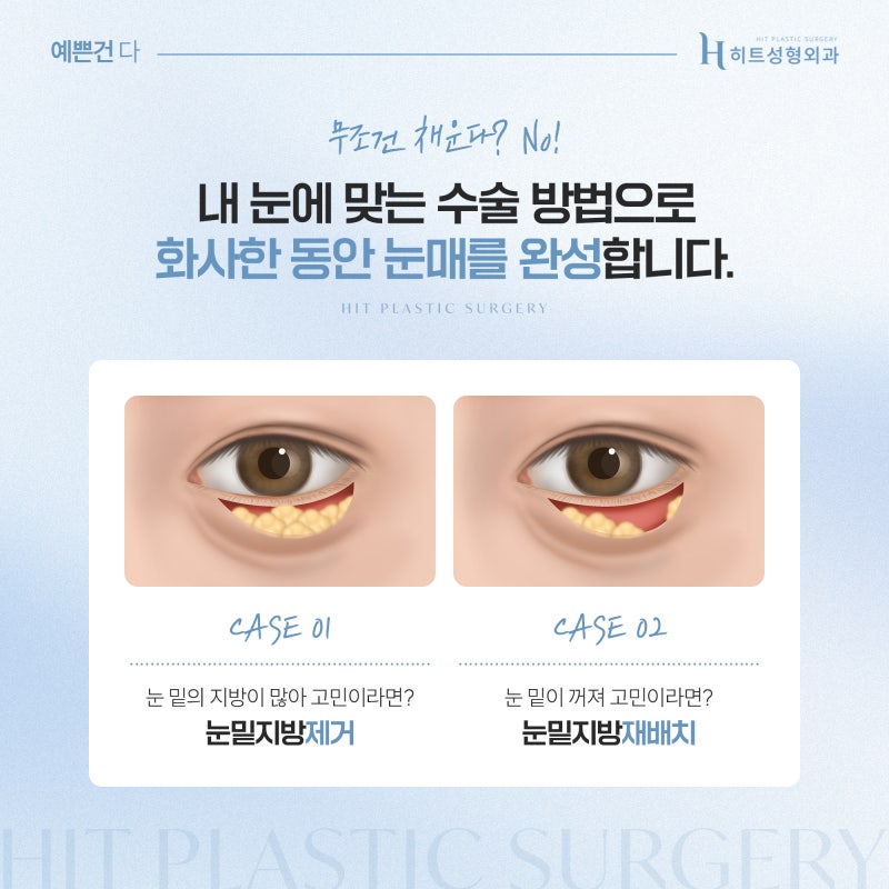 [히트성형외과] 눈밑지방재배치, 언제부터 자연스러워질까요? 사진 4