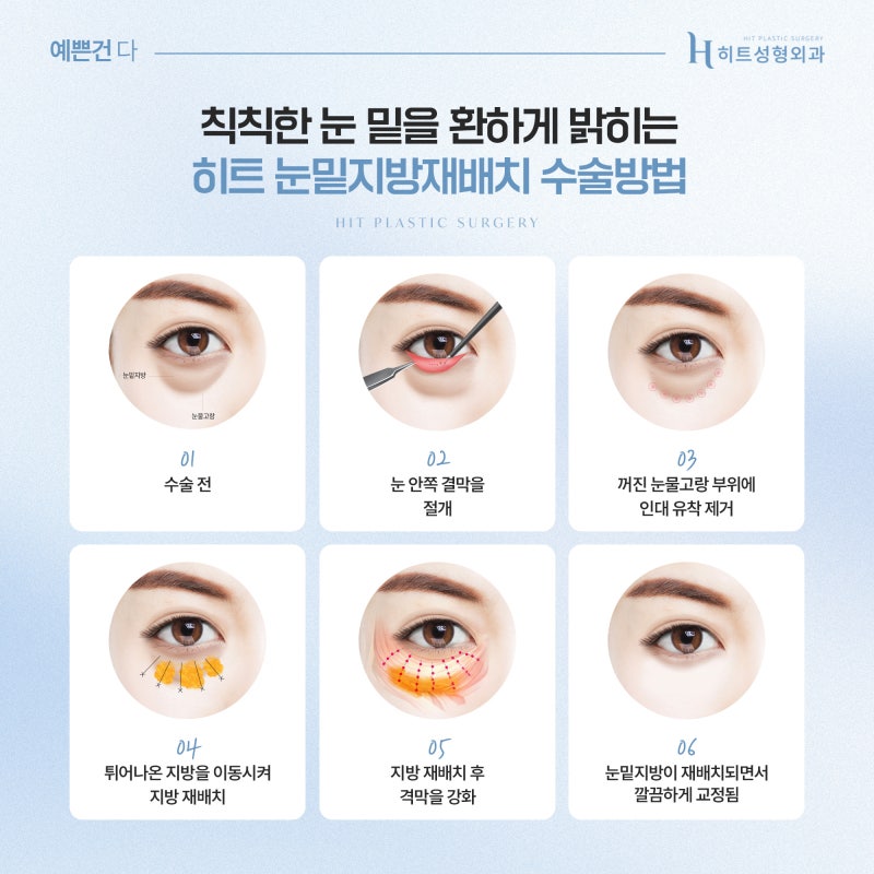[히트성형외과] 눈밑지방재배치, 언제부터 자연스러워질까요? 사진 5