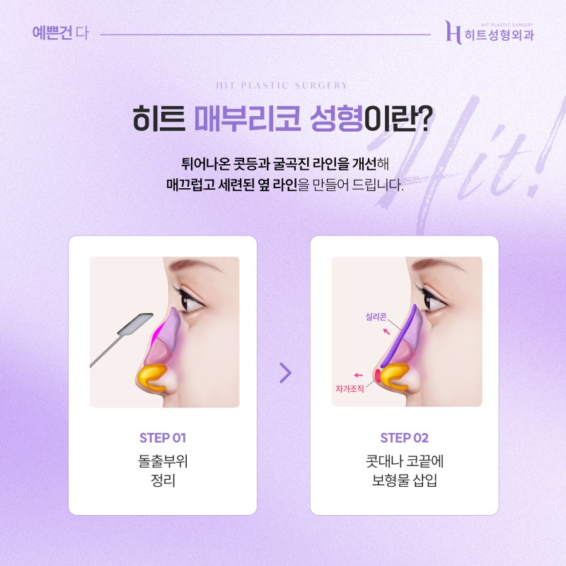 [히트성형외과] 콧대만 높이면 예뻐질까? 코성형 디자인의 중요성 사진 5