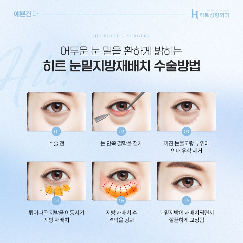 [히트성형외과] 피곤해 보이는 인상, 눈밑지방재배치로 개선될까? 사진 4