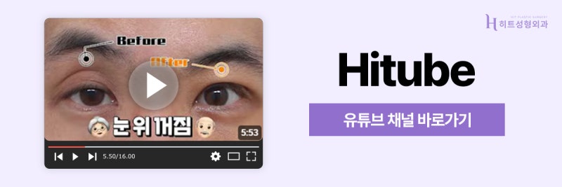 [히트성형외과] 눈 뜰 때 이마에 힘이 들어간다면? 안검하수 신호 사진 8