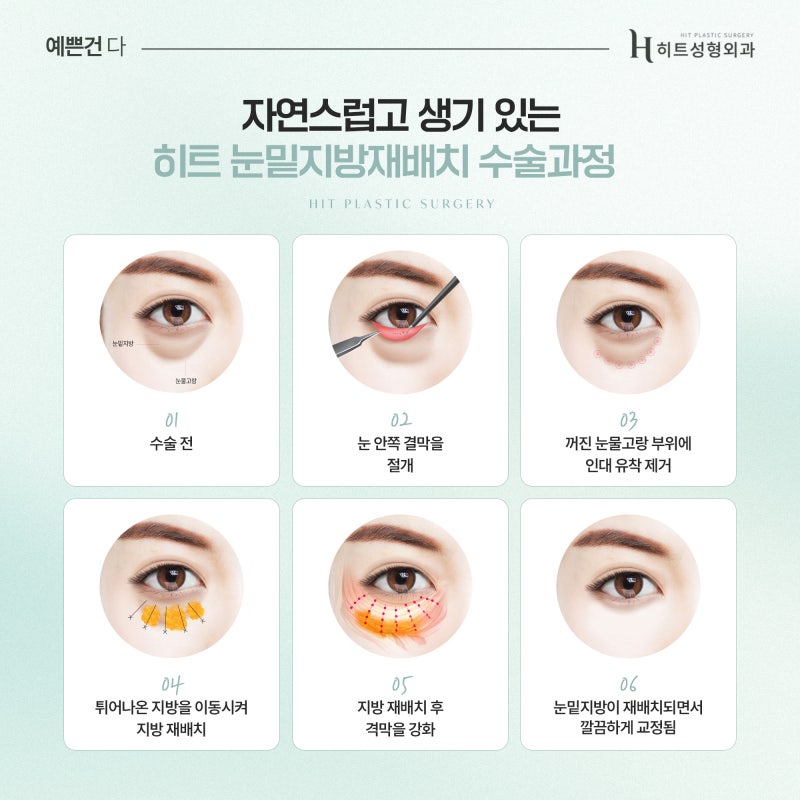[히트성형외과] 눈 밑 꺼짐 vs 지방 돌출, 어떤 수술이 필요할까? 사진 5