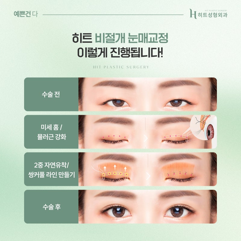 [히트성형외과] 눈꼬리 처짐 개선, 어떤 방법이 효과적일까? 사진 4