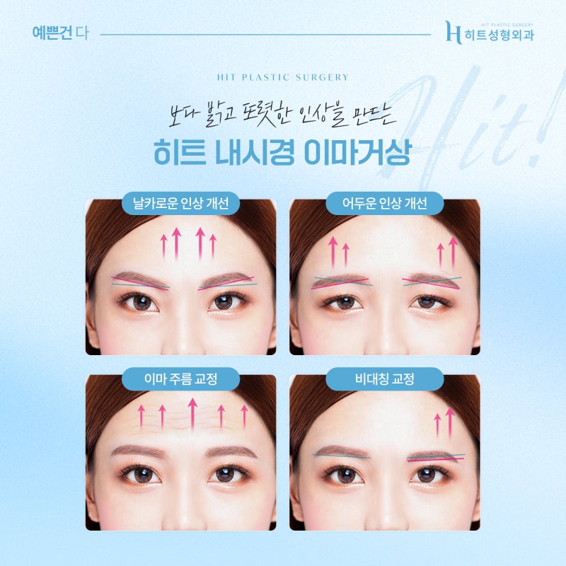 [히트성형외과] 이마거상 후 눈매가 또렷해지는 이유 사진 4