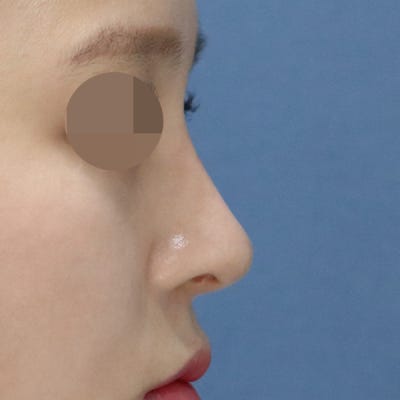 히트성형외과 코성형 (콧볼축소, 복코교정) 사진 4