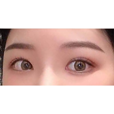 쌍꺼풀 겹주름이 눈성형을 하면? [히트성형외과] 사진 4