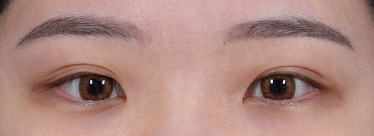 쌍꺼풀 겹주름이 눈성형을 하면? [히트성형외과]