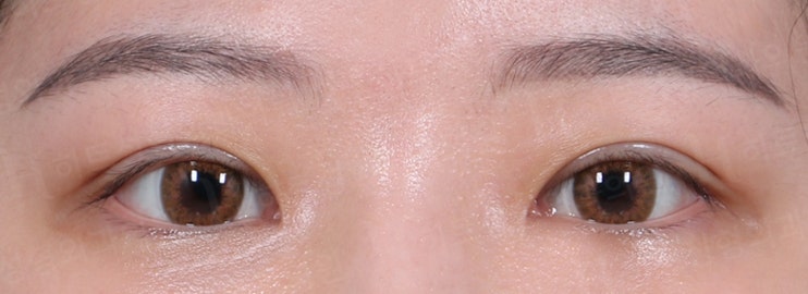 쌍꺼풀 겹주름이 눈성형을 하면? [히트성형외과] 사진 3