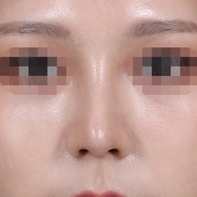 매부리코와 복코 동시 개선! [히트성형외과 코성형] 사진 2