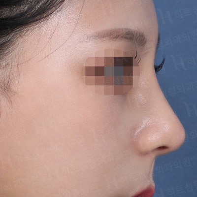 매부리코와 복코 동시 개선! [히트성형외과 코성형] 사진 6