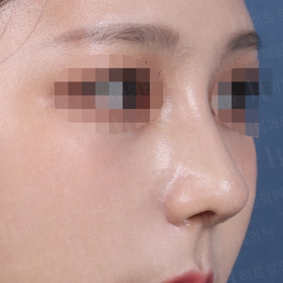 매부리코와 복코 동시 개선! [히트성형외과 코성형] 사진 4
