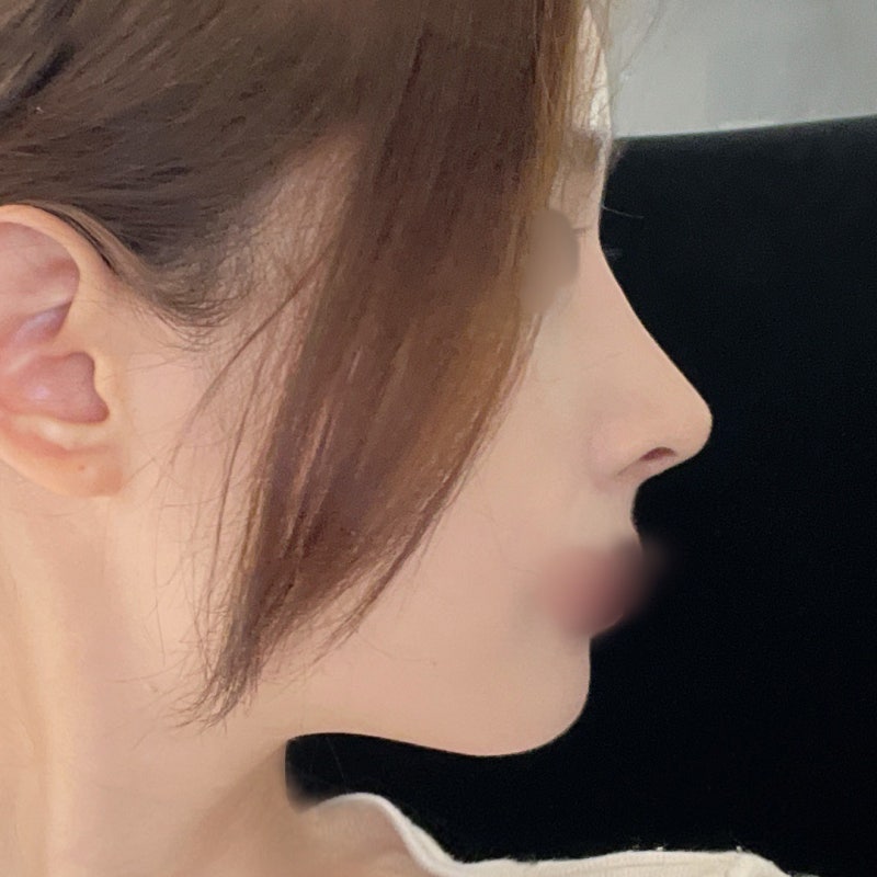 비순각 교정과 코끝교정으로 화살코 극복 [히트성형외과 코성형] 사진 5