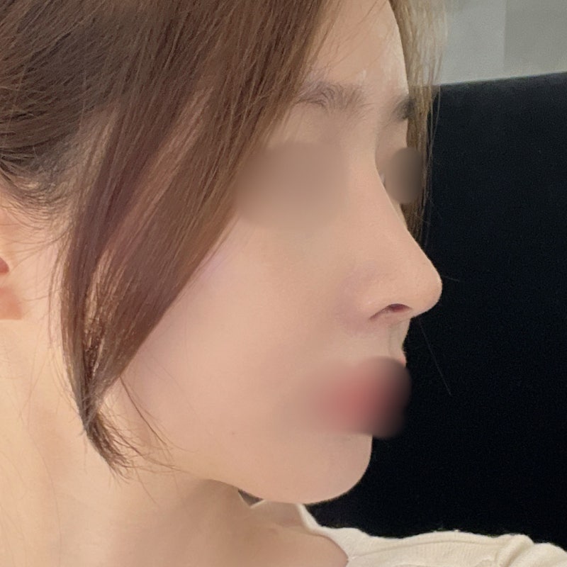 비순각 교정과 코끝교정으로 화살코 극복 [히트성형외과 코성형] 사진 6