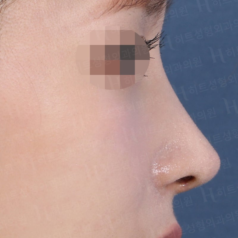 비순각 교정과 코끝교정으로 화살코 극복 [히트성형외과 코성형] 사진 4