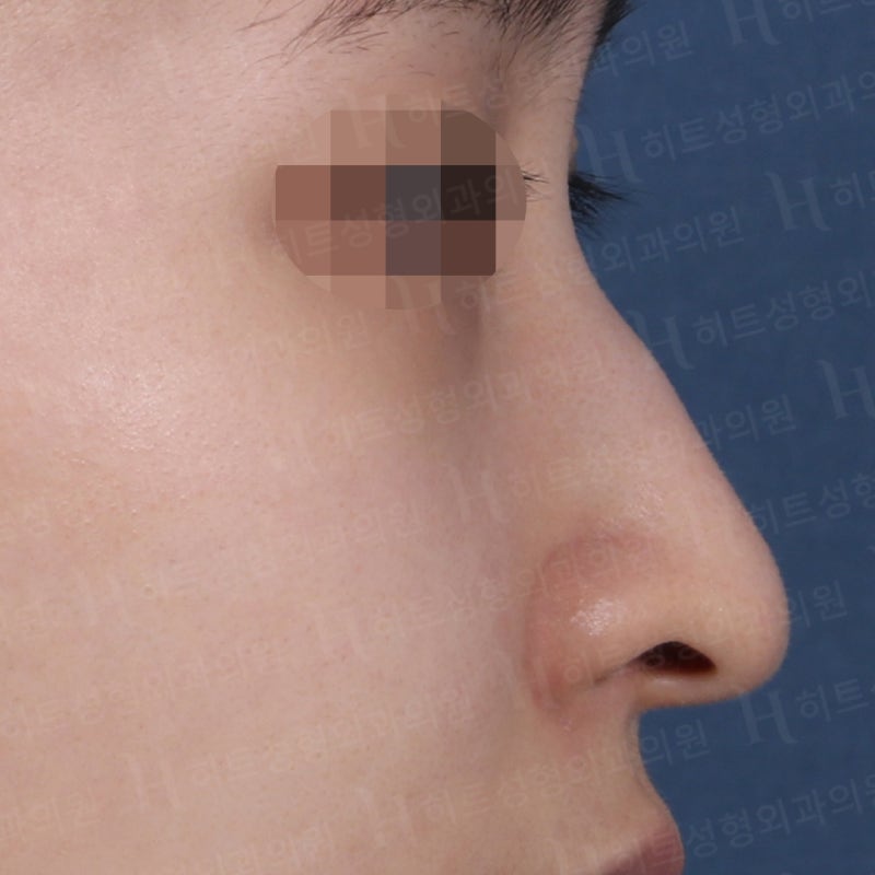 비순각 교정과 코끝교정으로 화살코 극복 [히트성형외과 코성형] 사진 3