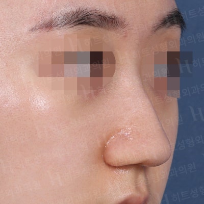 복코교정, 유형에 따라 다른 수술방법! [히트성형외과 코성형] 사진 3