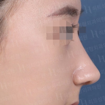 복코교정, 유형에 따라 다른 수술방법! [히트성형외과 코성형] 사진 6