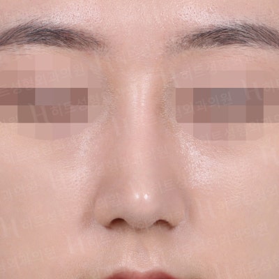복코교정, 유형에 따라 다른 수술방법! [히트성형외과 코성형] 사진 2