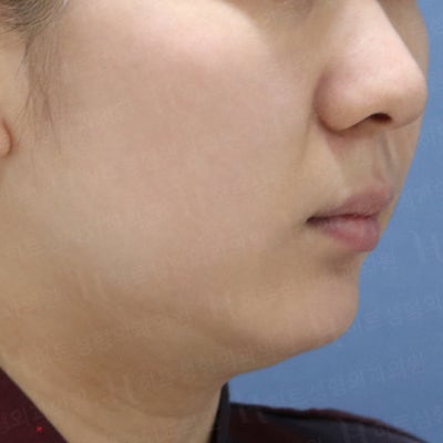 얼굴지방흡입! 갸름한 V라인 [히트성형외과] 사진 2