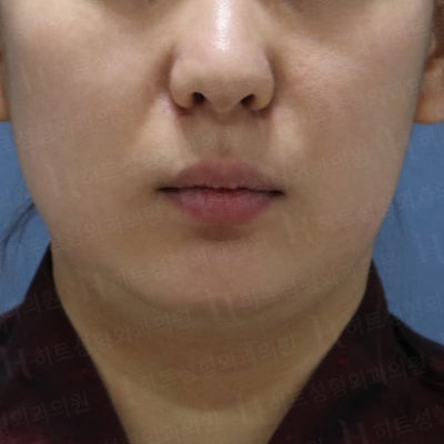 얼굴지방흡입! 갸름한 V라인 [히트성형외과]