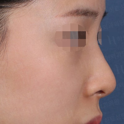 코성형 재수술 후기 [히트성형외과 코성형] 사진 3