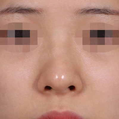 코성형 재수술 후기 [히트성형외과 코성형]